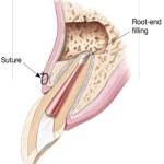 endo2