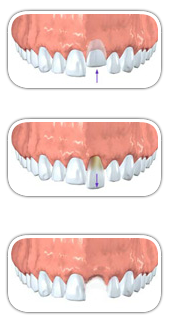 traumatic-tooth-injuries