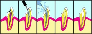 root canal 1